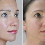 needling full face pigmentation
